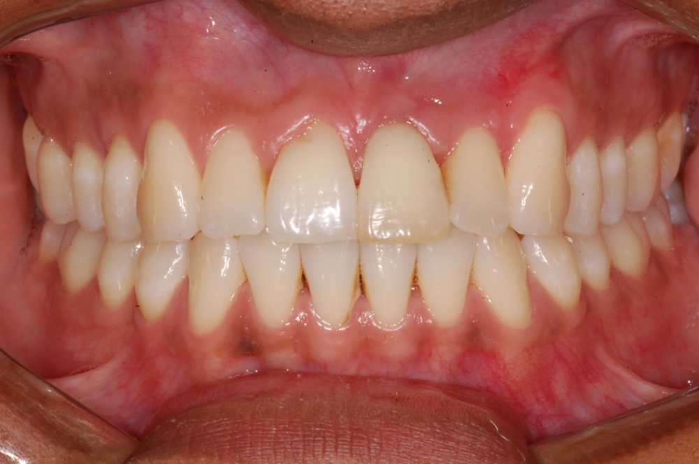 Imagem com Abertura do Diafragma f/22, observe que desde os incisivos centrais até aos molares estão nítidos.