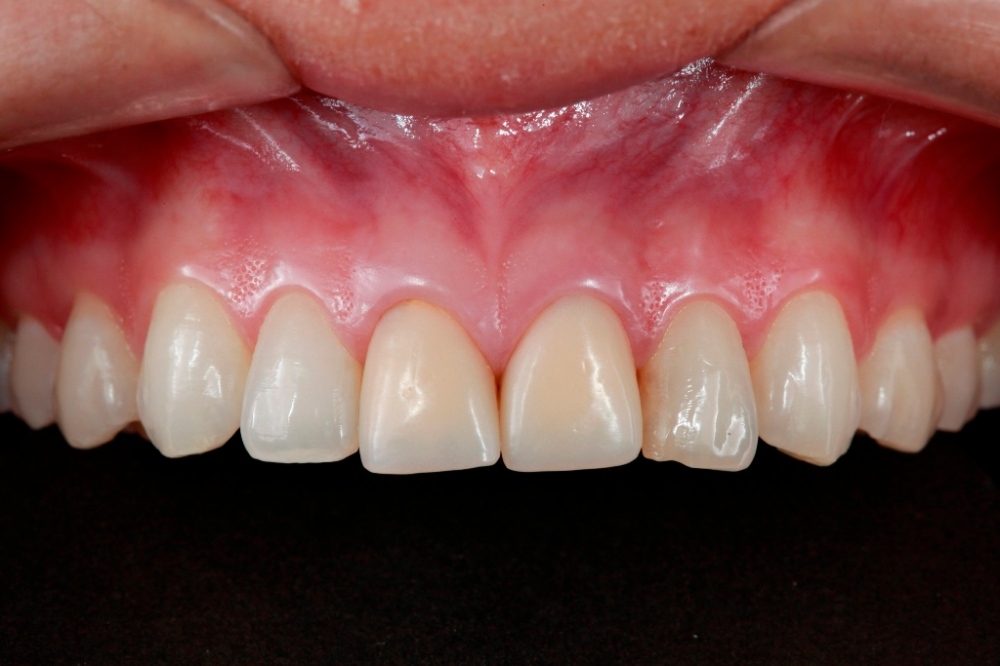 Perceba que os molares não estão com a mesma nitidez que os incisivos. Veja nas ampliações abaixo: